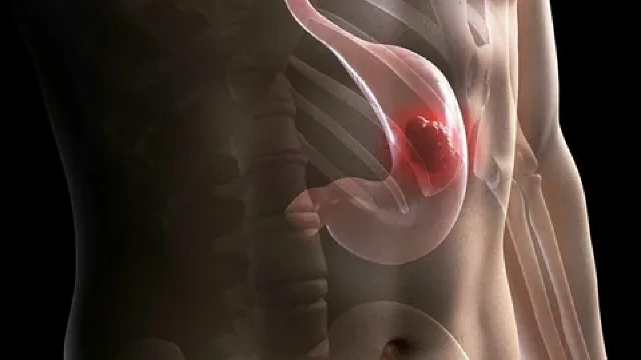 Mide kanserinin gizli tehdidi: Helicobacter pylori ve erken tanı…